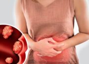 Hindari Makanan Ini untuk Cegah Kanker Usus