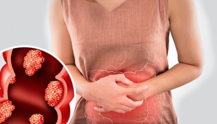 Hindari Makanan Ini untuk Cegah Kanker Usus