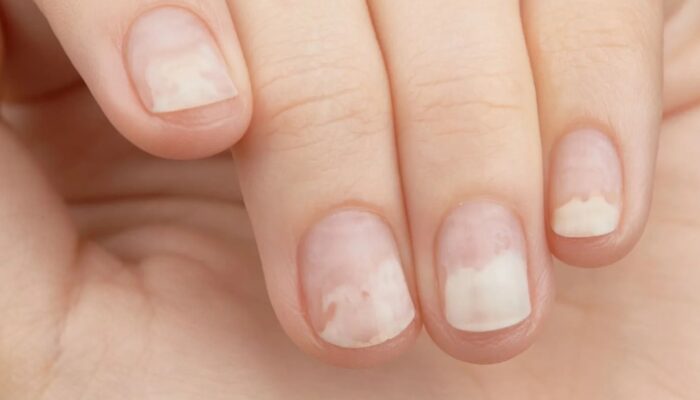 Kenali Kuku Tak Sehat, Bisa Jadi Sinyal Penyakit