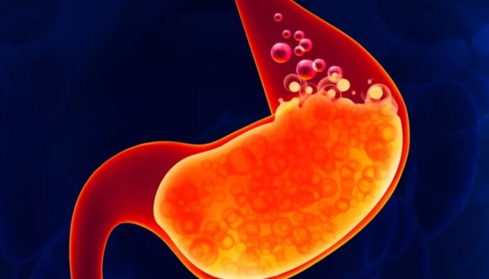 Kebiasaan Ini Bisa Picu Asam Lambung Naik